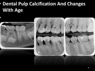 • Dental Pulp Calcification And Changes
With Age
•
76
 