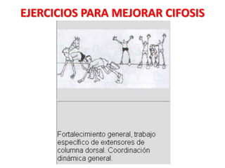 EJERCICIOS PARA MEJORAR CIFOSIS
 