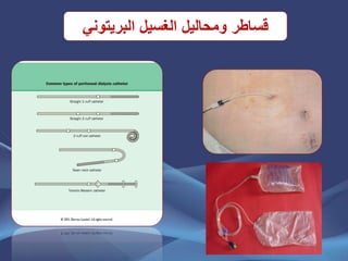 ‫البريتوني‬ ‫الغسيل‬ ‫ومحاليل‬ ‫قساطر‬
 