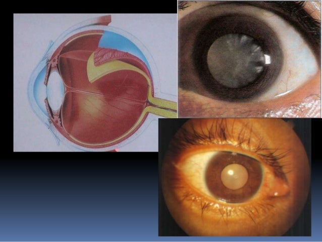 pinpoint pupils diabetes pinpoint pupils diabetes