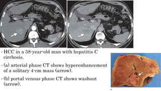 Hcc Ct Pattern patterns of enhancement in hepatocellular carcinoma | PPTX