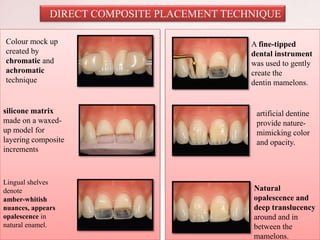 DIRECT COMPOSITE PLACEMENT TECHNIQUE
Colour mock up
created by
chromatic and
achromatic
technique
silicone matrix
made on a waxed-
up model for
layering composite
increments
Lingual shelves
denote
amber-whitish
nuances, appears
opalescence in
natural enamel.
A fine-tipped
dental instrument
was used to gently
create the
dentin mamelons.
artificial dentine
provide nature-
mimicking color
and opacity.
Natural
opalescence and
deep translucency
around and in
between the
mamelons.
 