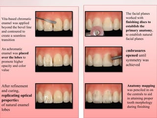 Vita-based chromatic
enamel was applied
beyond the bevel line
and contoured to
create a seamless
transition
An achromatic
enamel was placed
over the lobes to
promote higher
opacity and color
value
After refinement
and curing,
replicating optical
properties
of natural enamel
lobes
The facial planes
worked with
finishing discs to
establish the
primary anatomy,
to establish natural
facial planes
embrasures
opened until
symmetry was
achieved
Anatomy mapping
was penciled in on
the centrals to aid
in attaining proper
tooth morphology
during finishing
 