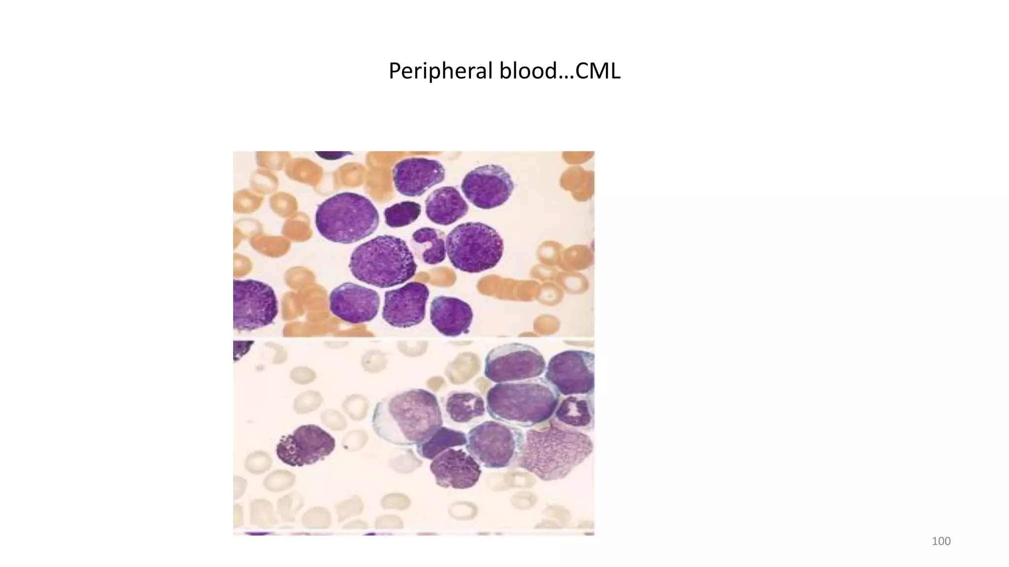 Peripheral blood…CML
100
 