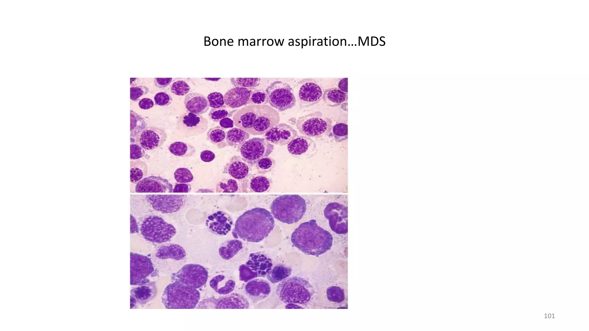 Bone marrow aspiration…MDS
101
 