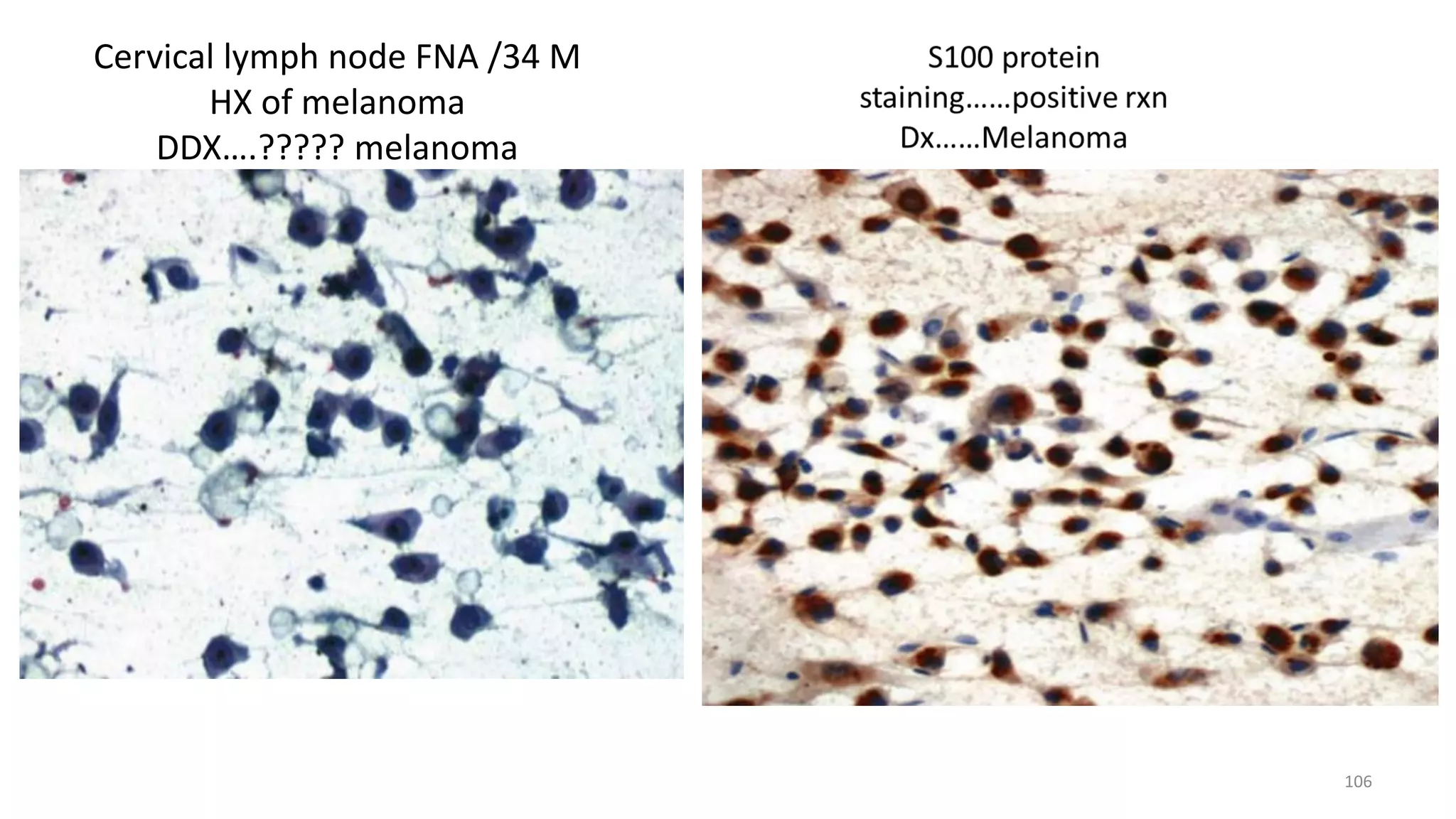 Cervical lymph node FNA /34 M
HX of melanoma
DDX….????? melanoma
106
 