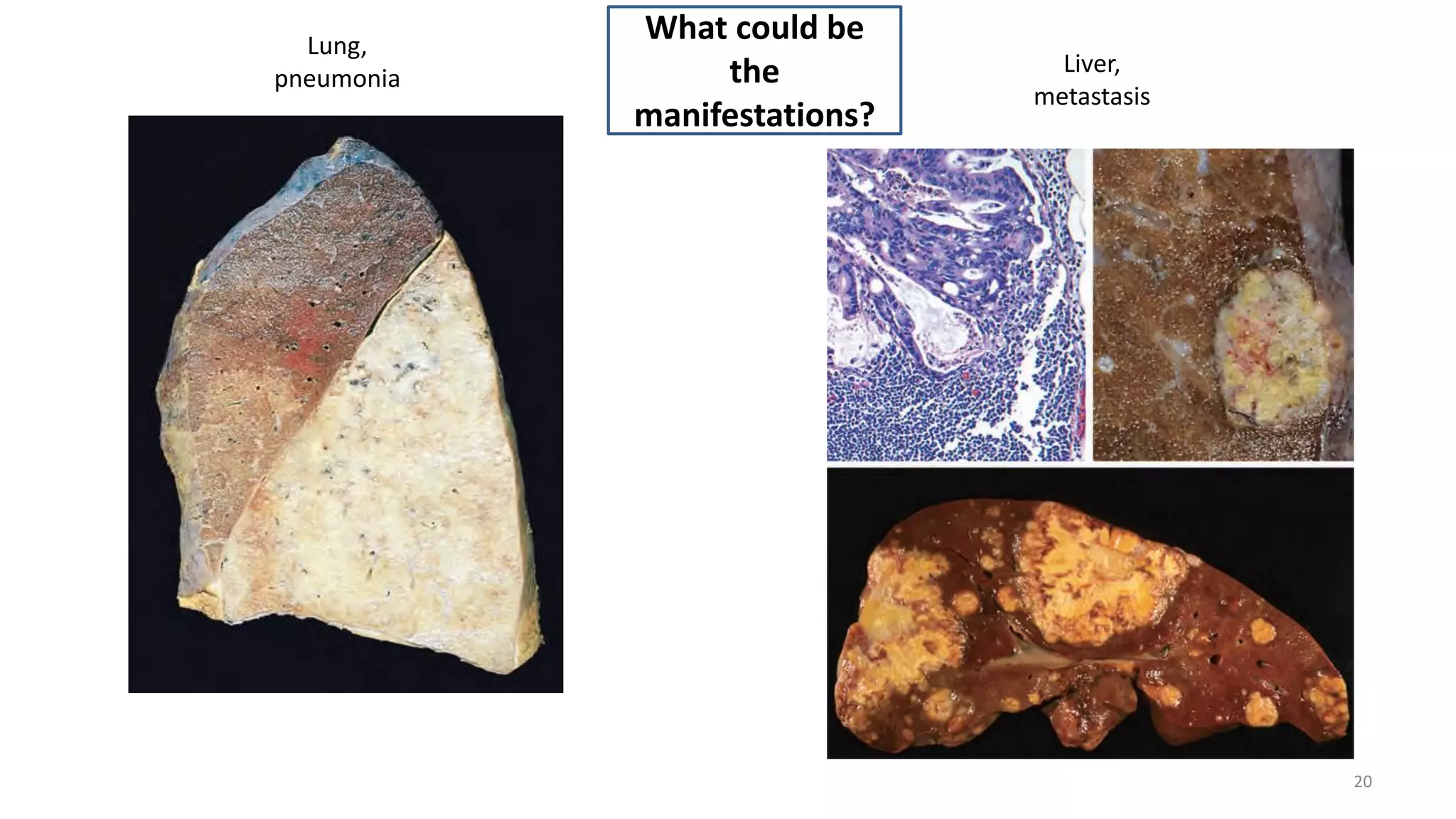 20
Lung,
pneumonia
Liver,
metastasis
What could be
the
manifestations?
 