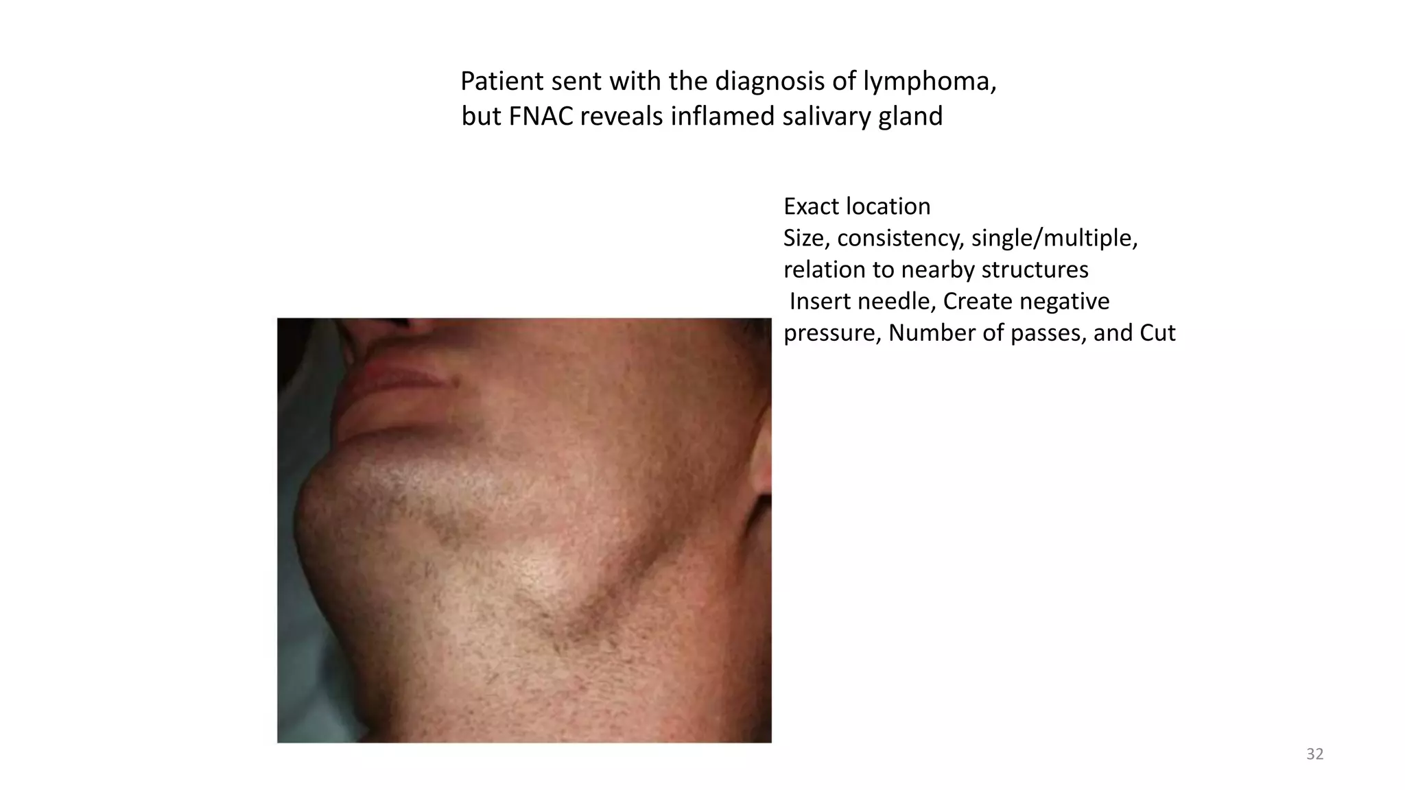 Patient sent with the diagnosis of lymphoma,
but FNAC reveals inflamed salivary gland
Exact location
Size, consistency, single/multiple,
relation to nearby structures
Insert needle, Create negative
pressure, Number of passes, and Cut
32
 