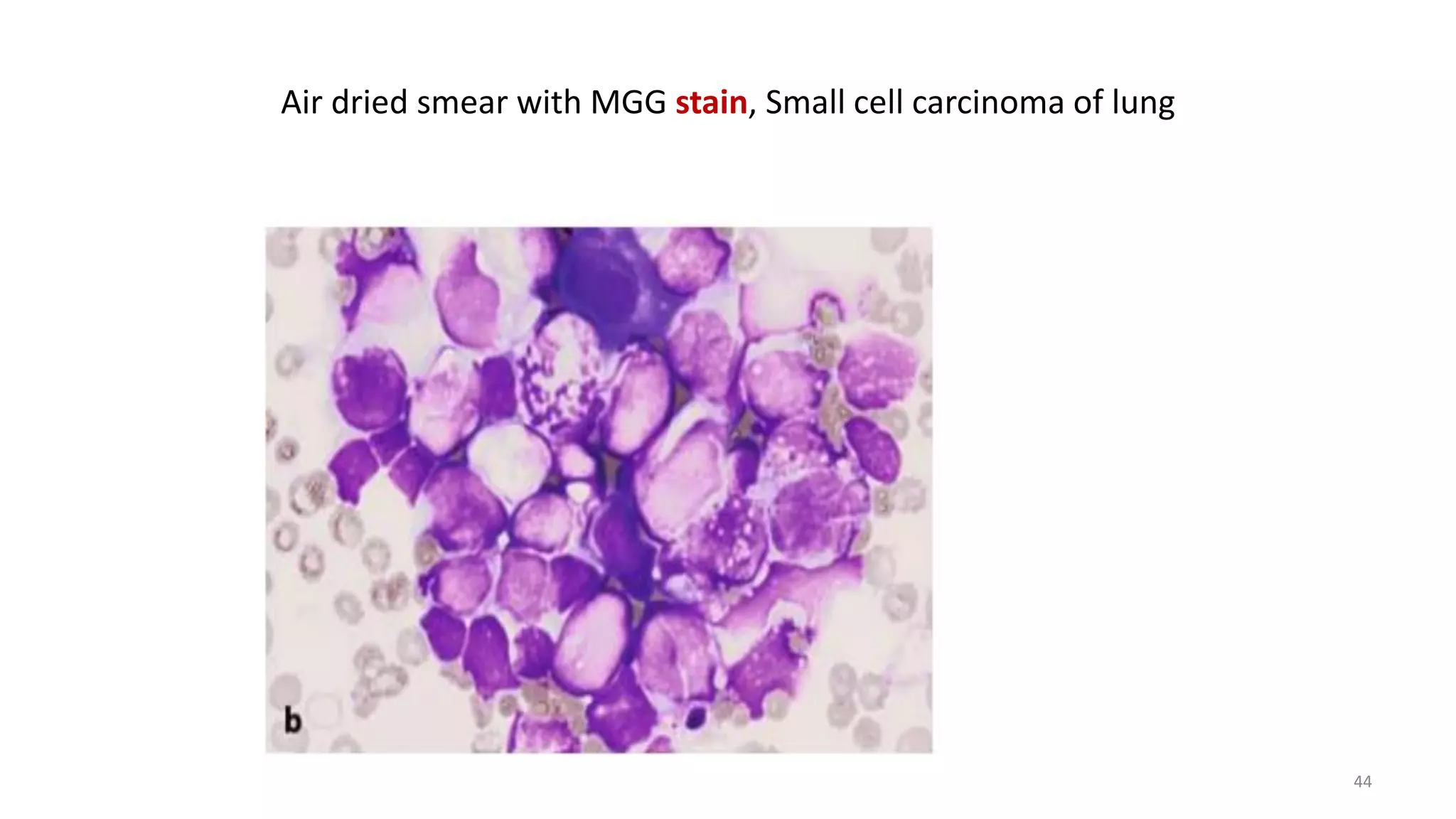Air dried smear with MGG stain, Small cell carcinoma of lung
44
 