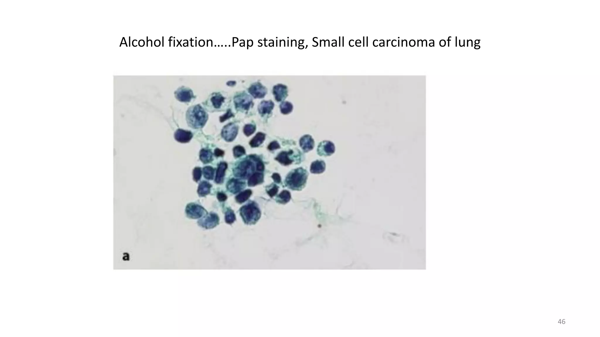 Alcohol fixation…..Pap staining, Small cell carcinoma of lung
46
 