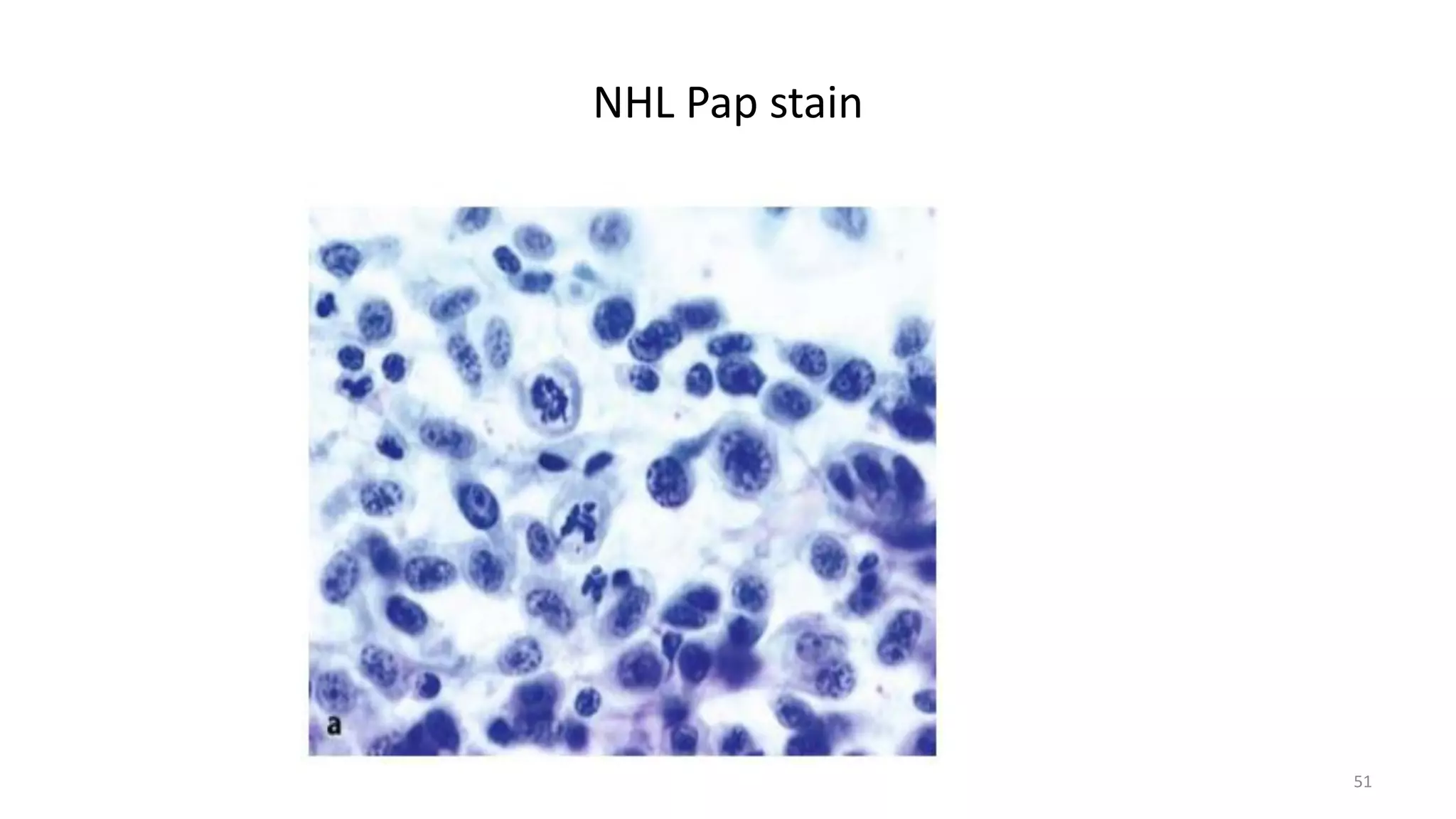 NHL Pap stain
51
 