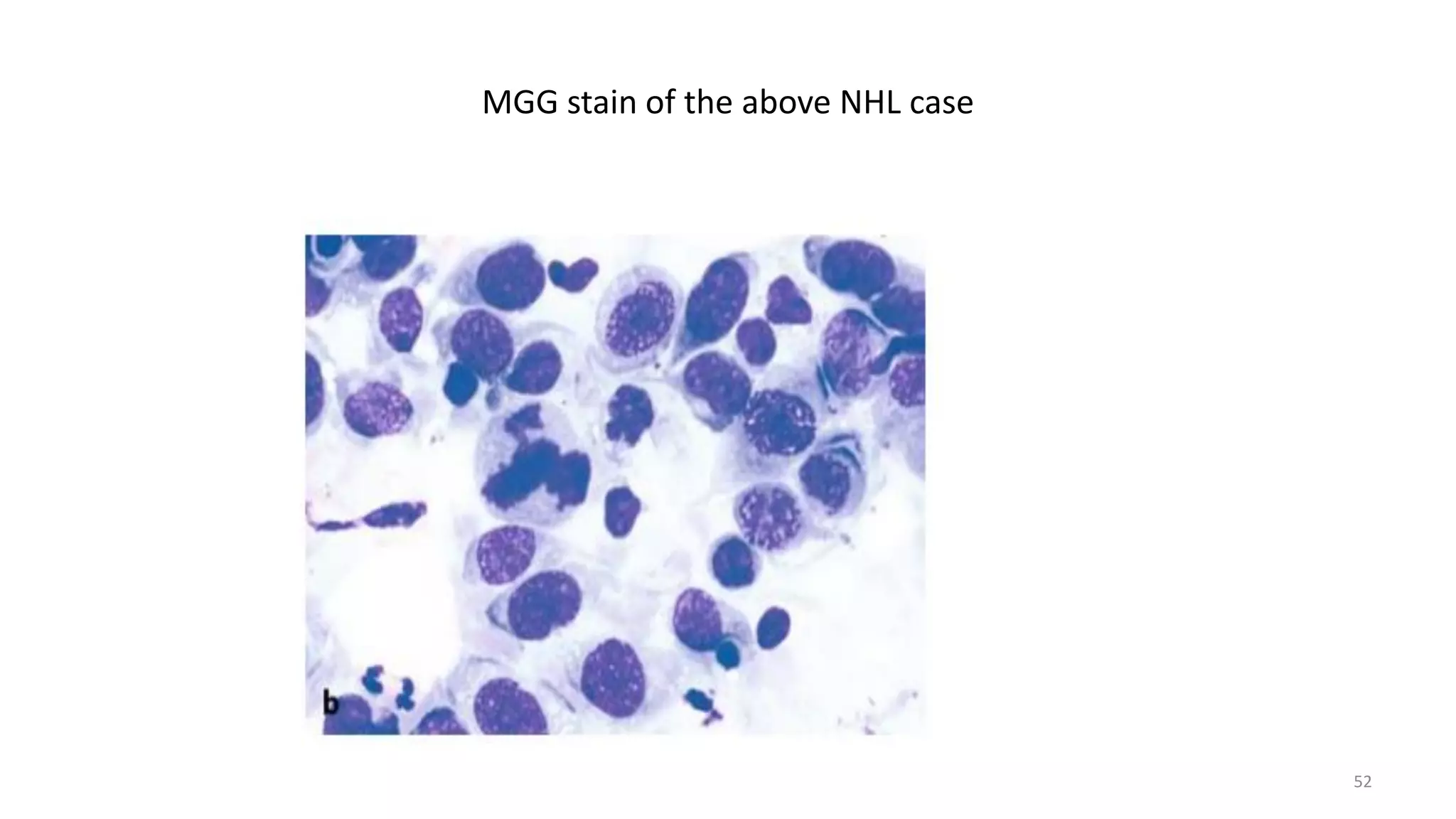 MGG stain of the above NHL case
52
 