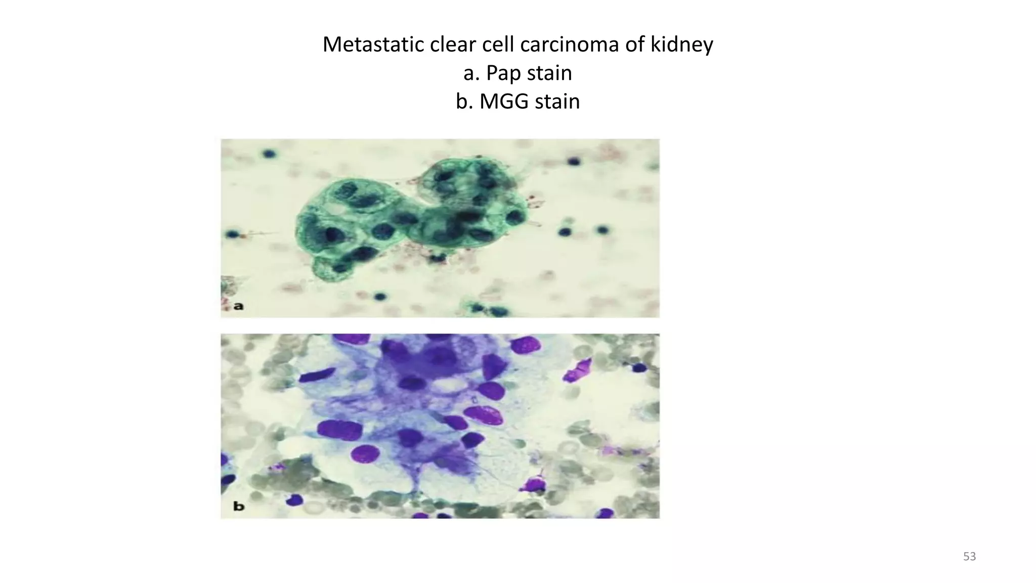 Metastatic clear cell carcinoma of kidney
a. Pap stain
b. MGG stain
53
 