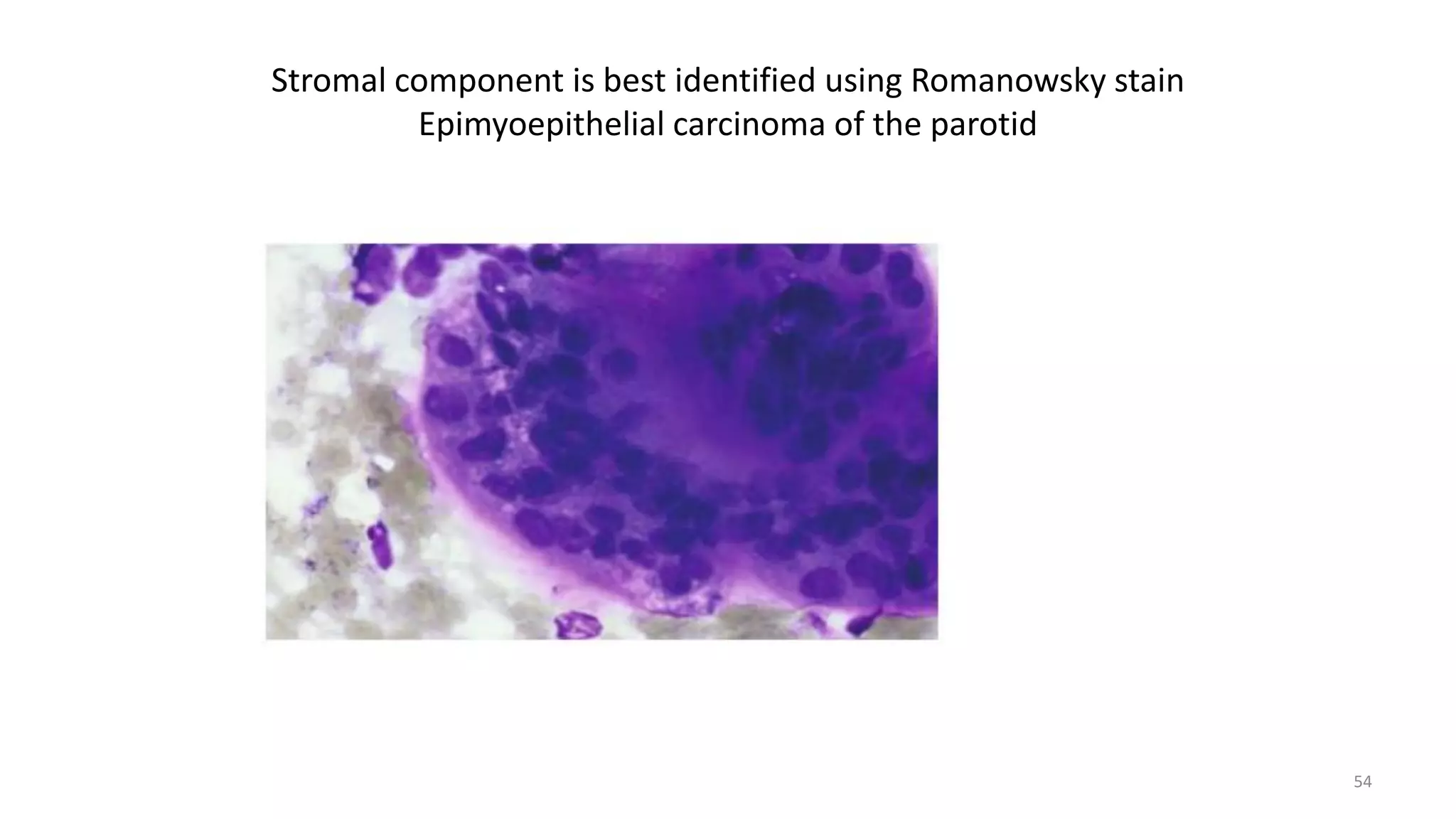 Stromal component is best identified using Romanowsky stain
Epimyoepithelial carcinoma of the parotid
54
 