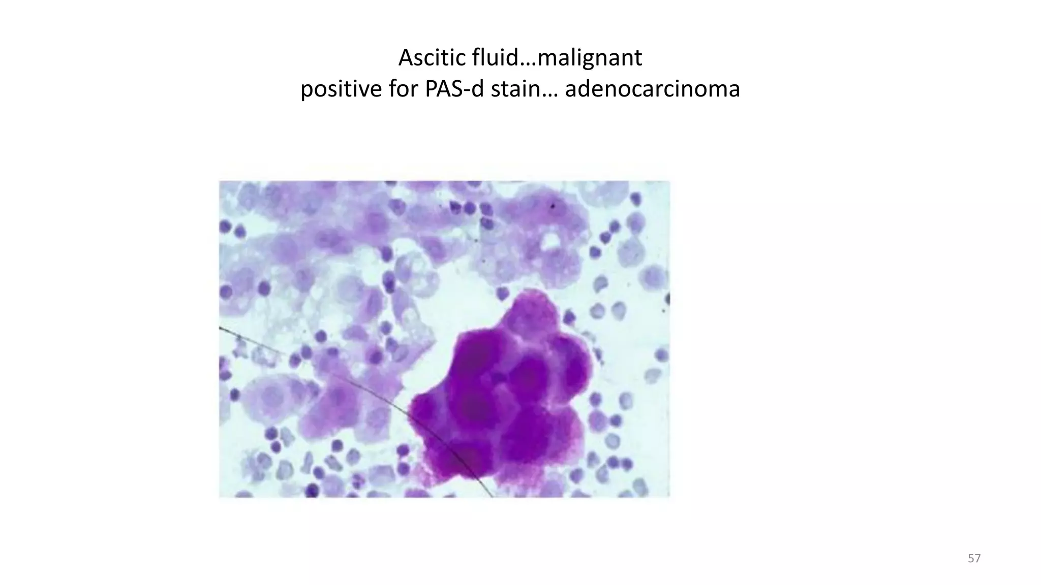 Ascitic fluid…malignant
positive for PAS-d stain… adenocarcinoma
57
 
