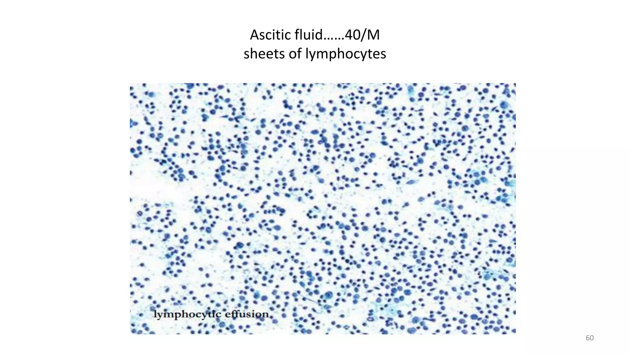 Ascitic fluid……40/M
sheets of lymphocytes
60
 