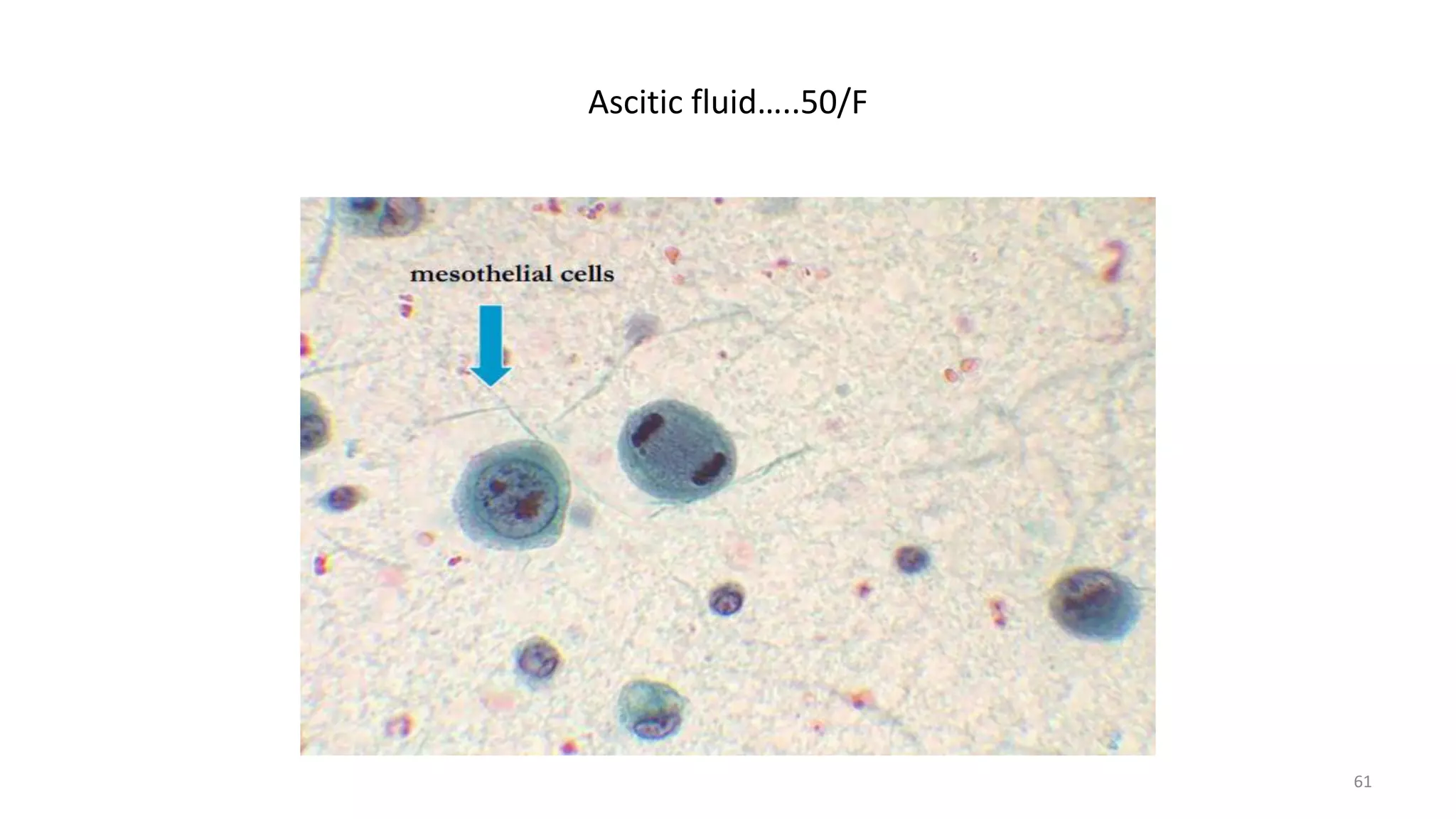Ascitic fluid…..50/F
61
 