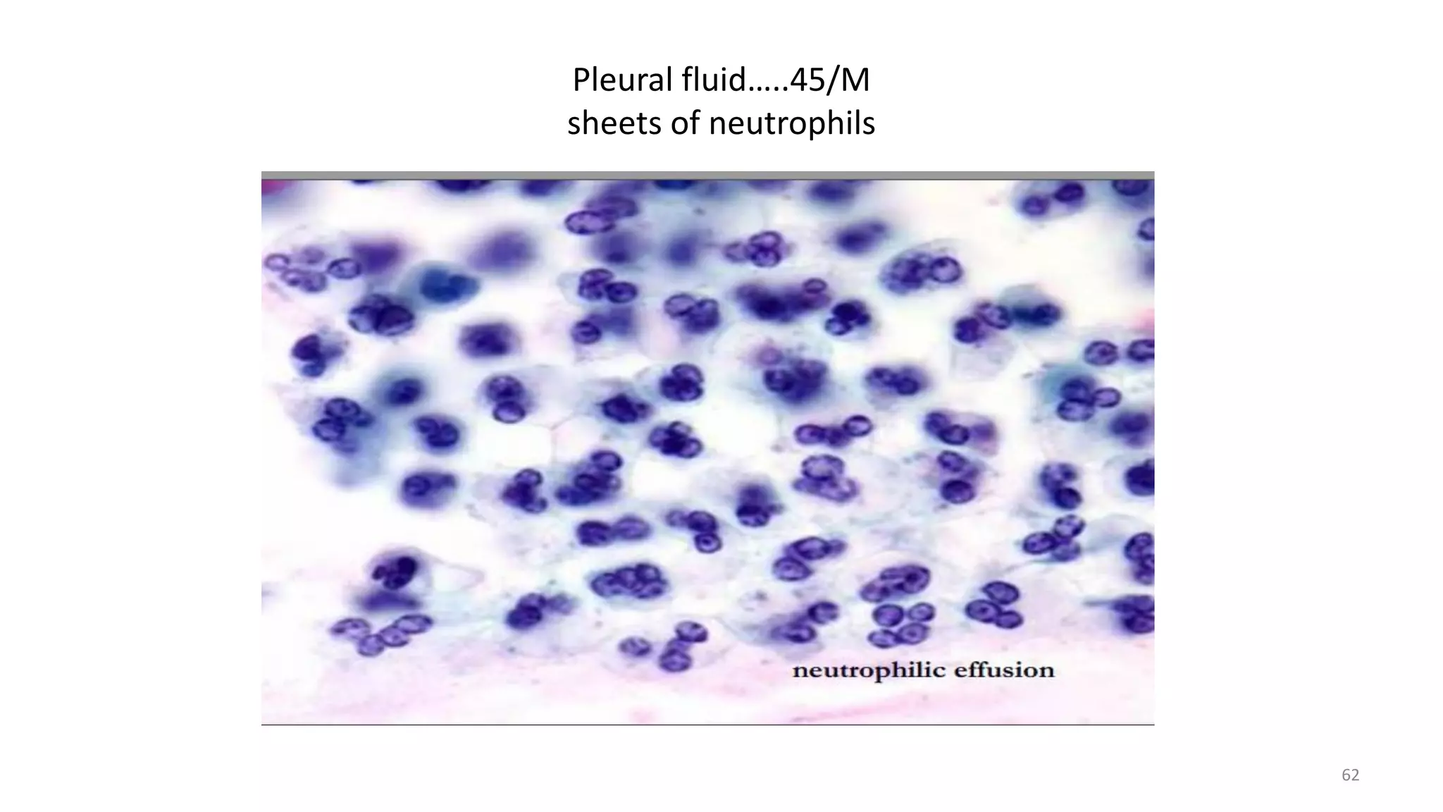 Pleural fluid…..45/M
sheets of neutrophils
62
 