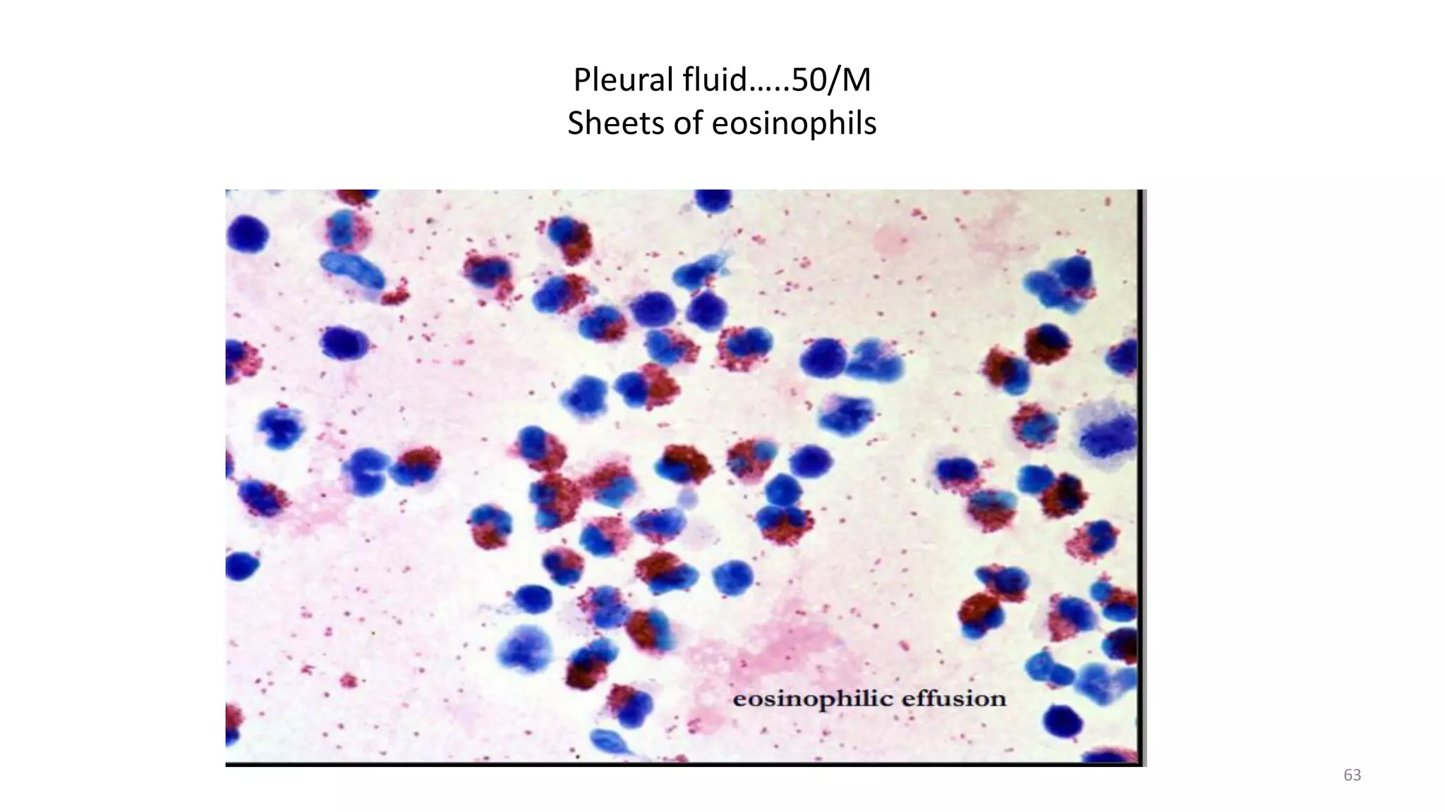 Pleural fluid…..50/M
Sheets of eosinophils
63
 