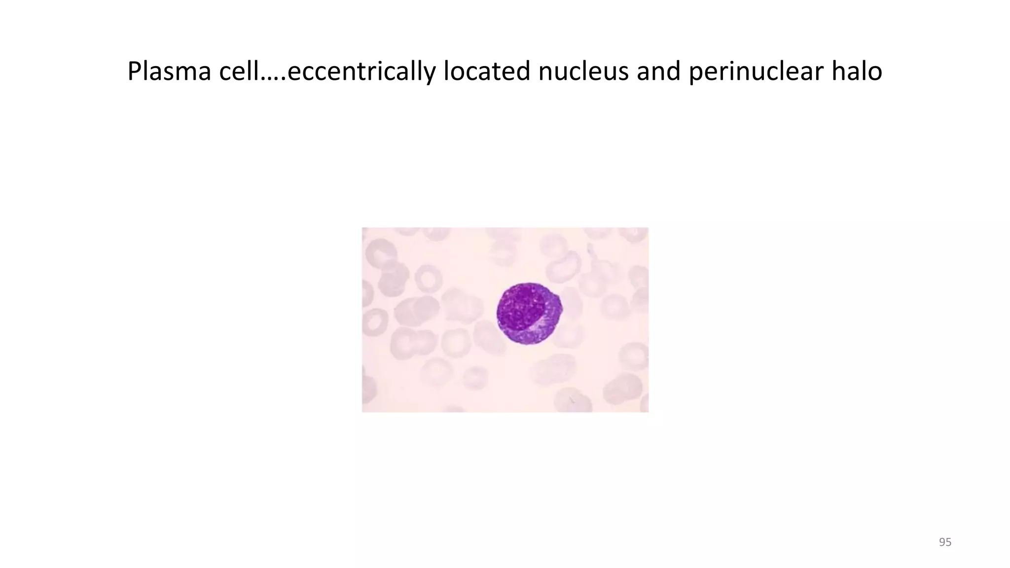 Plasma cell….eccentrically located nucleus and perinuclear halo
95
 