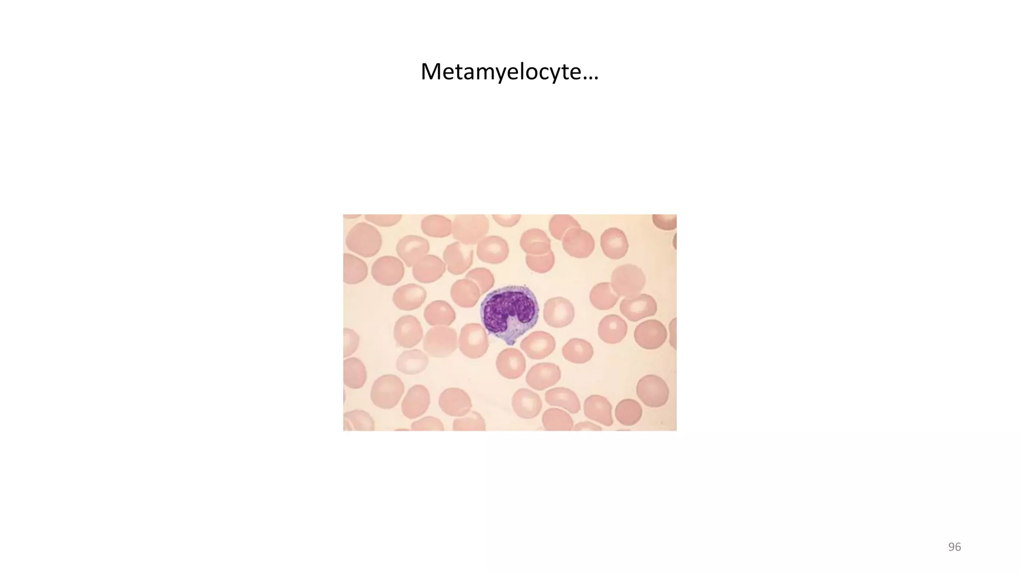 Metamyelocyte…
96
 