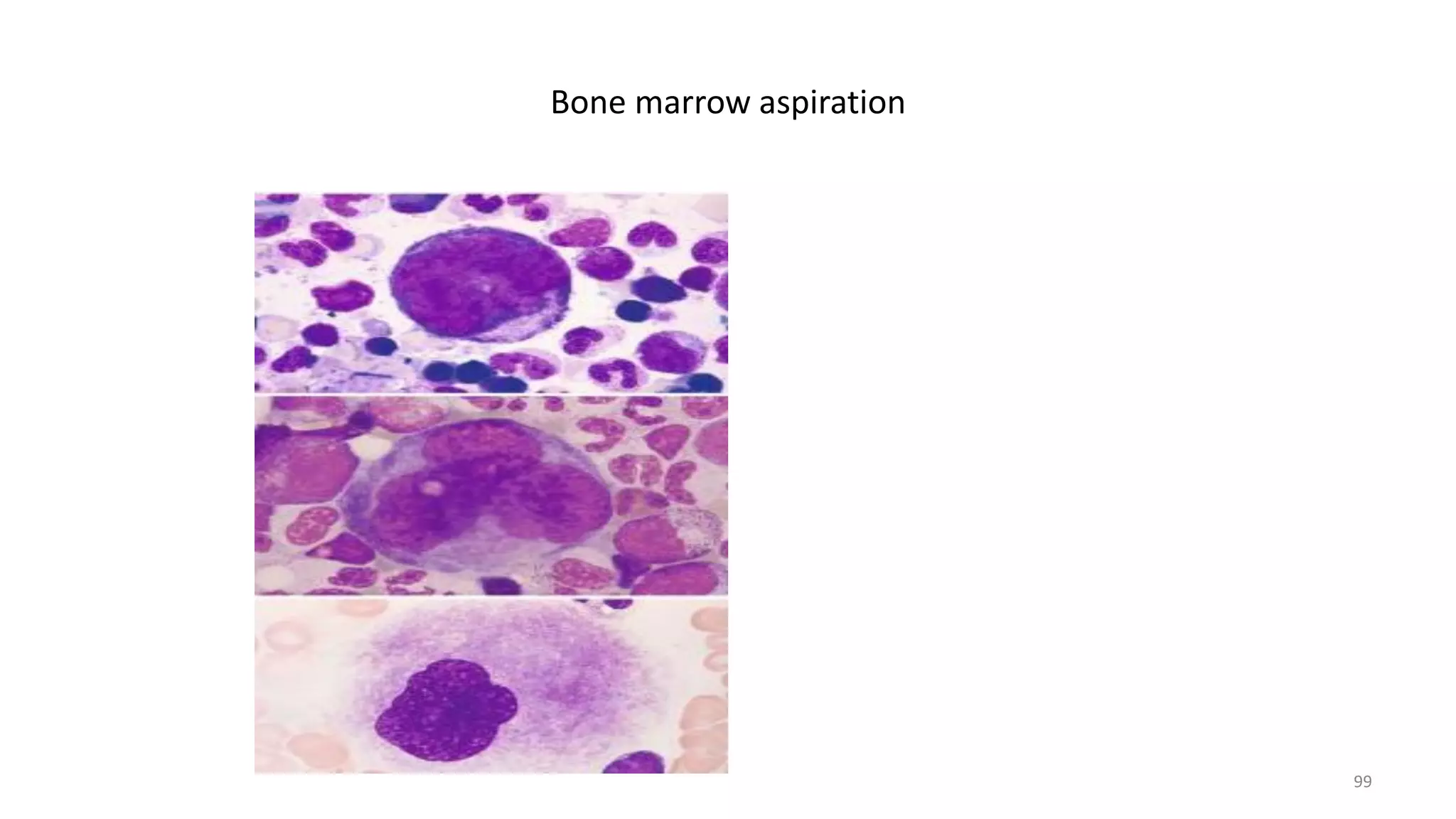 Bone marrow aspiration
99
 