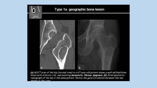 Radiological Approach To Bone Tumours | PPTX