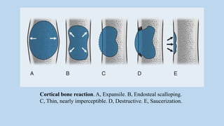 Radiological Approach To Bone Tumours | PPTX