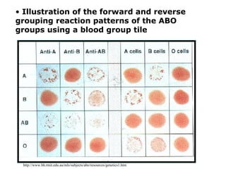 • Illustration of the forward and reverse
grouping reaction patterns of the ABO
groups using a blood group tile
http://www.bh.rmit.edu.au/mls/subjects/abo/resources/genetics1.htm
 
