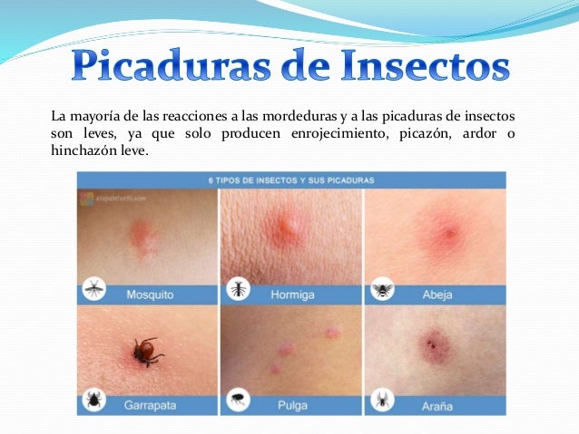 Primeros auxilios contra picaduras ( perros y gatos) y Mordeduras