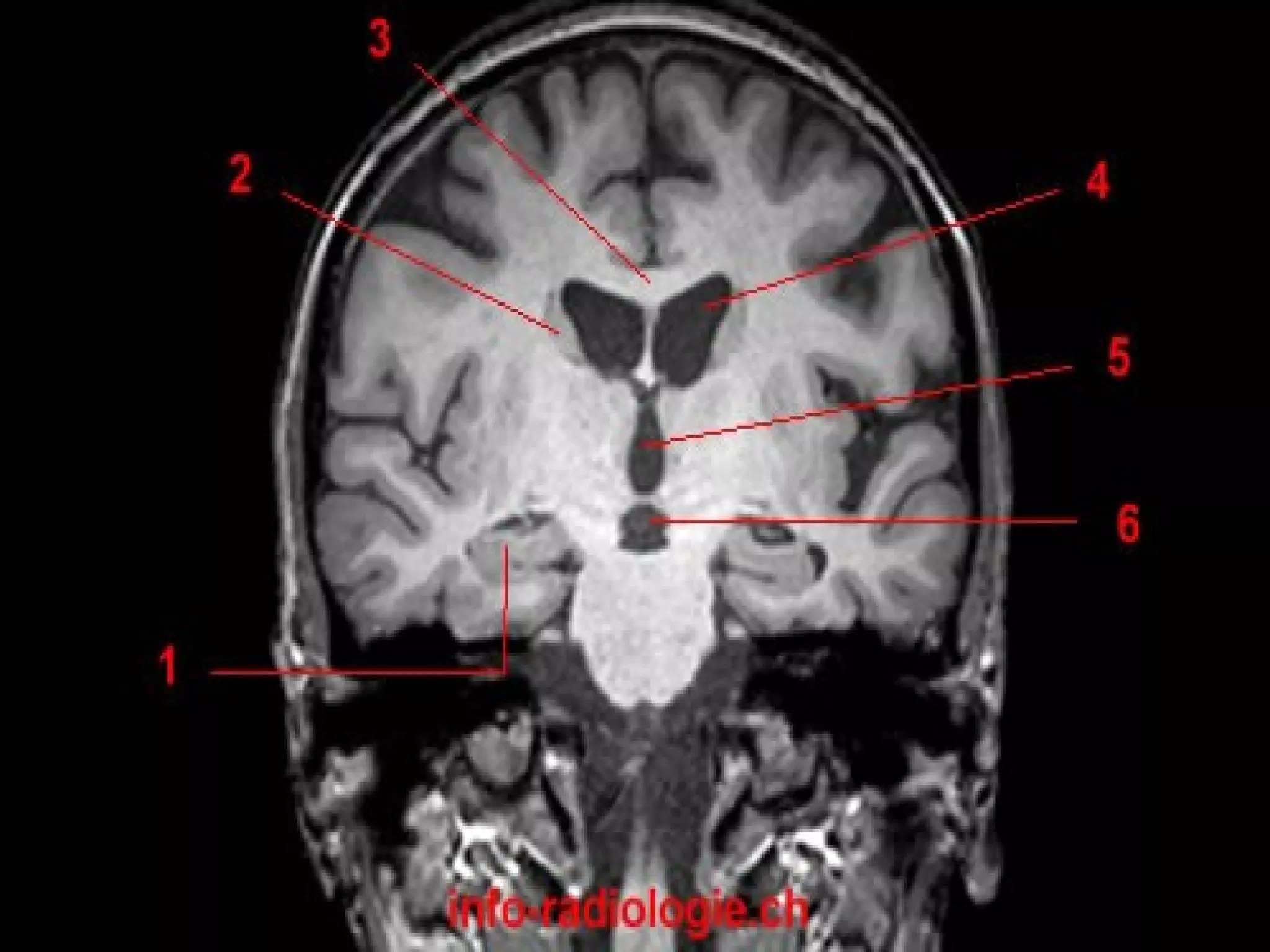 Radiological anatomy of the brain | PPT
