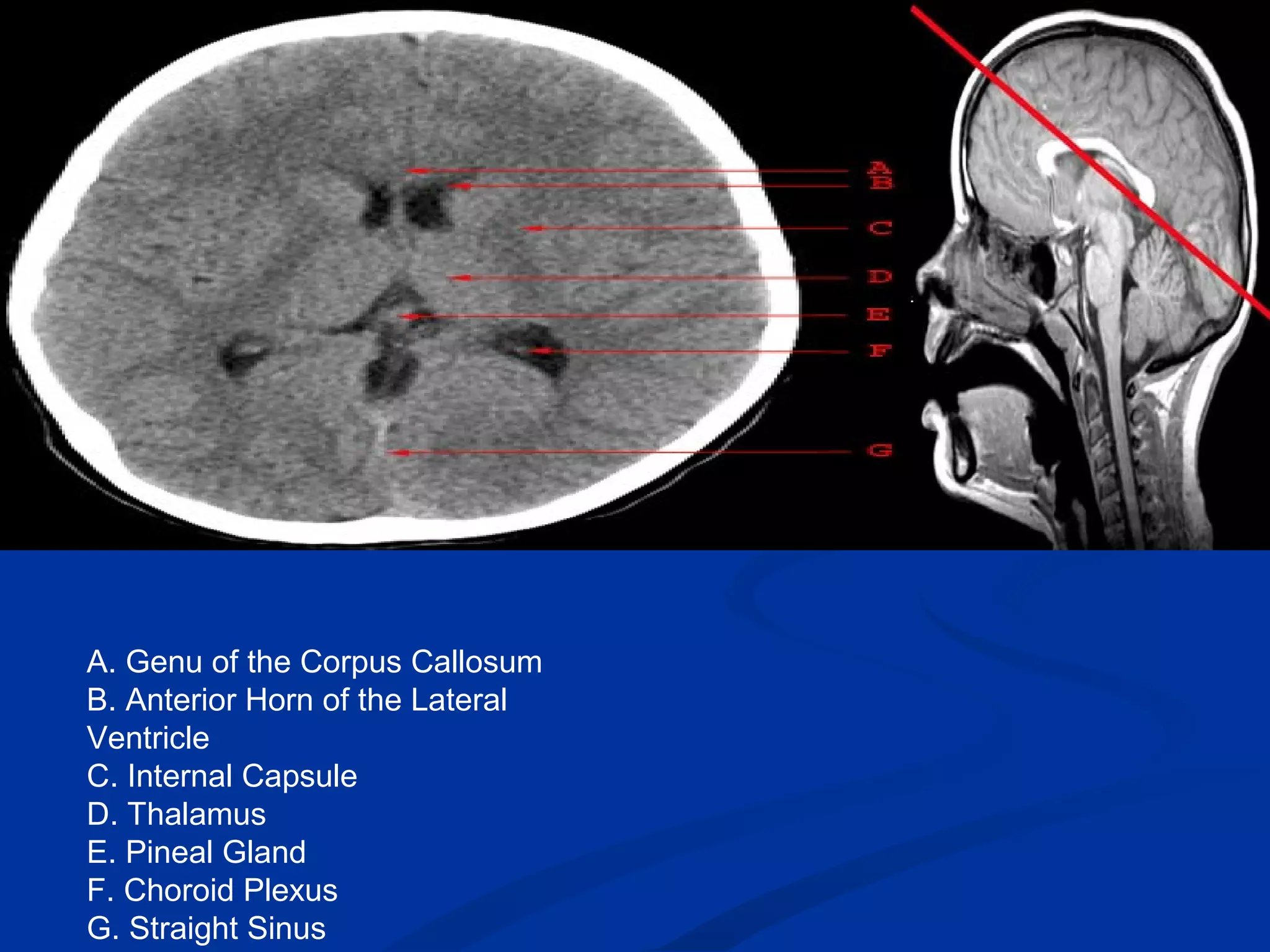 Radiological anatomy of the brain | PPT | Death, Injury, or Military ...