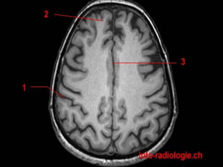 Radiological anatomy of the brain | PPT