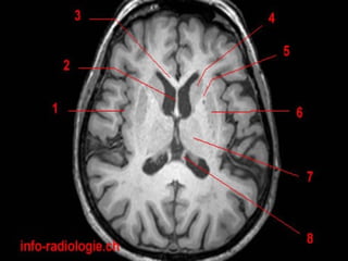 Radiological anatomy of the brain | PPT