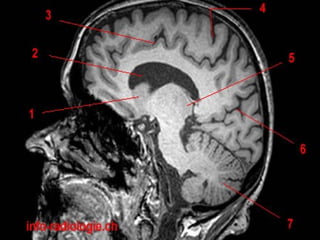 Radiological anatomy of the brain | PPT