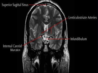 Radiological anatomy of the brain | PPT
