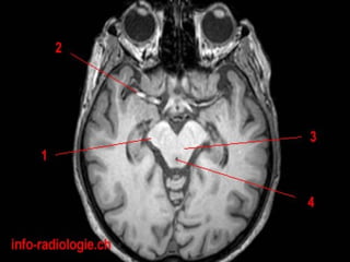 Radiological anatomy of the brain | PPT
