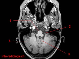 Radiological anatomy of the brain | PPT