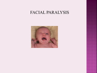 FACIAL PARALYSIS
 