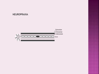 Axon
Epineurium
Perineurium
Endoneurium
NEUROPRAXIA
 