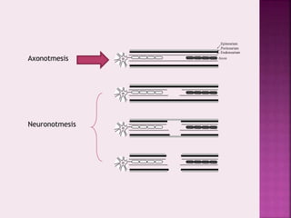 Axon
Epineurium
Perineurium
Endoneurium
Axonotmesis
Neuronotmesis
 