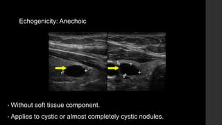 Echogenicity: Anechoic
• Without soft tissue component.
• Applies to cystic or almost completely cystic nodules.
 