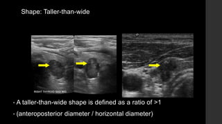 Shape: Taller-than-wide
• A taller-than-wide shape is defined as a ratio of >1
• (anteroposterior diameter / horizontal diameter)
 