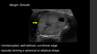 Margin: Smooth
• Uninterrupted, well-defined, curvilinear edge
• typically forming a spherical or elliptical shape
 