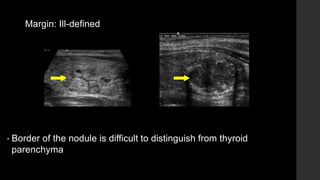 Margin: Ill-defined
• Border of the nodule is difficult to distinguish from thyroid
parenchyma
 