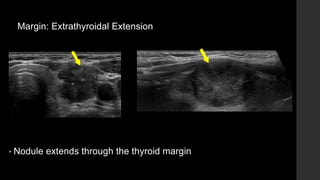 Margin: Extrathyroidal Extension
• Nodule extends through the thyroid margin
 