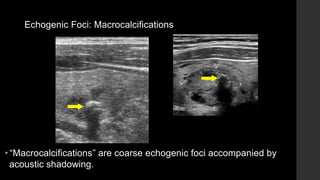 Echogenic Foci: Macrocalcifications
• “Macrocalcifications” are coarse echogenic foci accompanied by
acoustic shadowing.
 