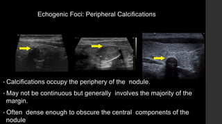 Echogenic Foci: Peripheral Calcifications
• Calcifications occupy the periphery of the nodule.
• May not be continuous but generally involves the majority of the
margin.
• Often dense enough to obscure the central components of the
nodule
 