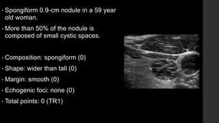 • Spongiform 0.9-cm nodule in a 59 year
old woman.
• More than 50% of the nodule is
composed of small cystic spaces.
• Composition: spongiform (0)
• Shape: wider than tall (0)
• Margin: smooth (0)
• Echogenic foci: none (0)
• Total points: 0 (TR1)
 
