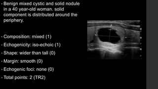 • Benign mixed cystic and solid nodule
in a 40 year-old woman. solid
component is distributed around the
periphery.
• Composition: mixed (1)
• Echogenicity: iso-echoic (1)
• Shape: wider than tall (0)
• Margin: smooth (0)
• Echogenic foci: none (0)
• Total points: 2 (TR2)
 
